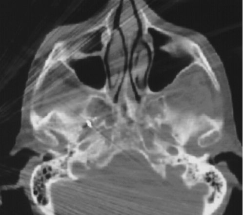 CT-Schicht mit korrekt iegender Nadel im rechten Foramenovale